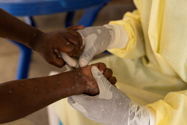 Un infirmier de laboratoire prenant un échantillon d'un enfant suspecté de Mpox