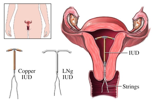 Strings can partner feel iud How to
