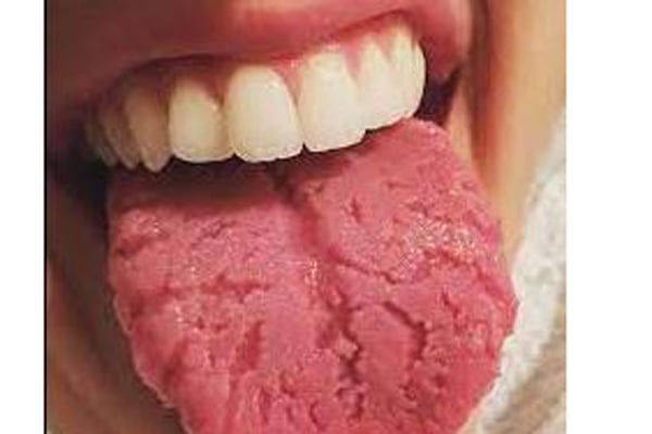 Natural Ways To Treat A Cracked Tongue Monitor 
