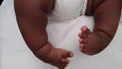 Clubfoot Why It Happens And How Doctors Treat It Daily Monitor