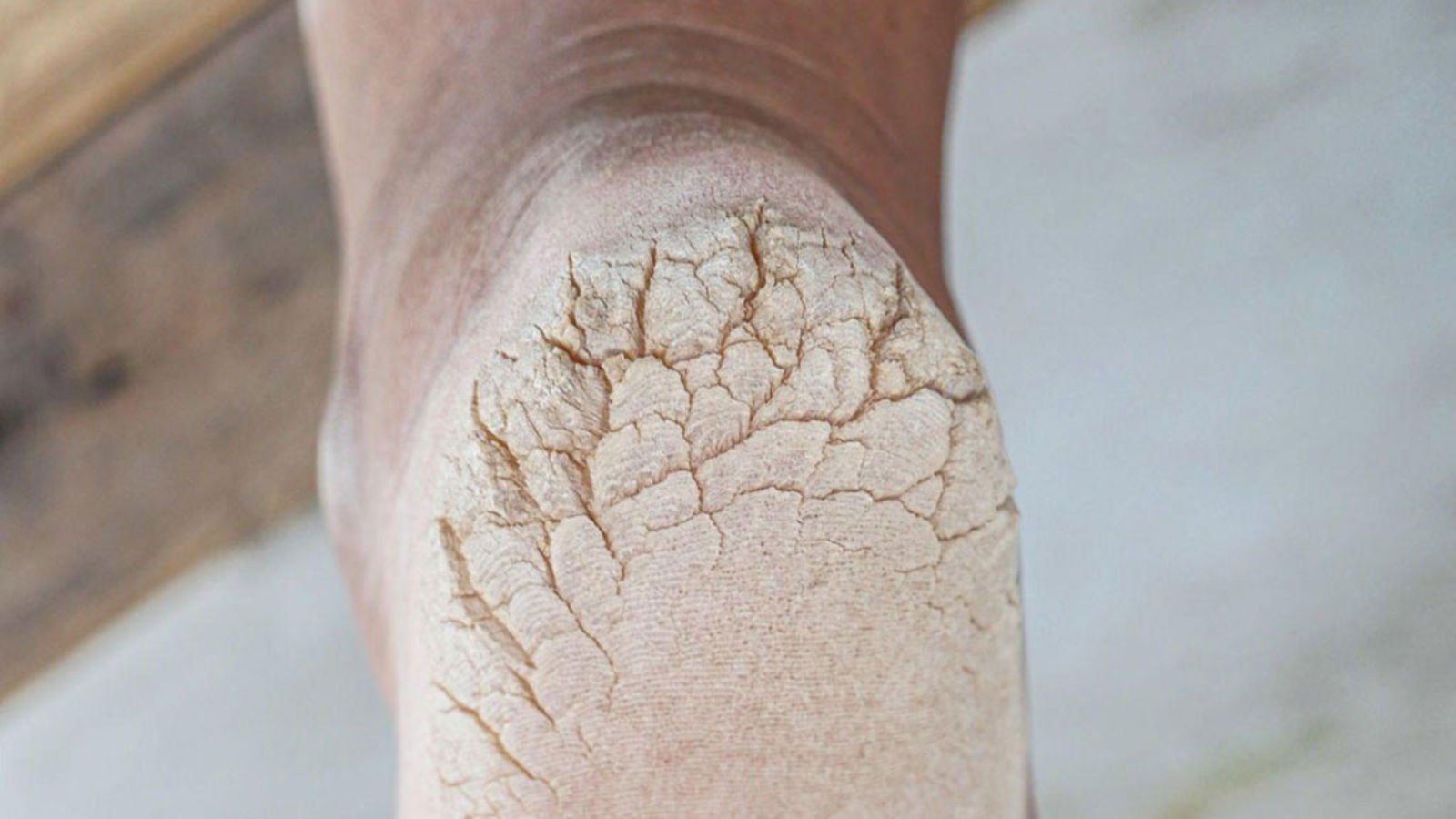 Anti Dry Cracked Heels 40% Urea Cream Moisturizing Foot Cream - China  Cosmetics and Body Care price | Made-in-China.com